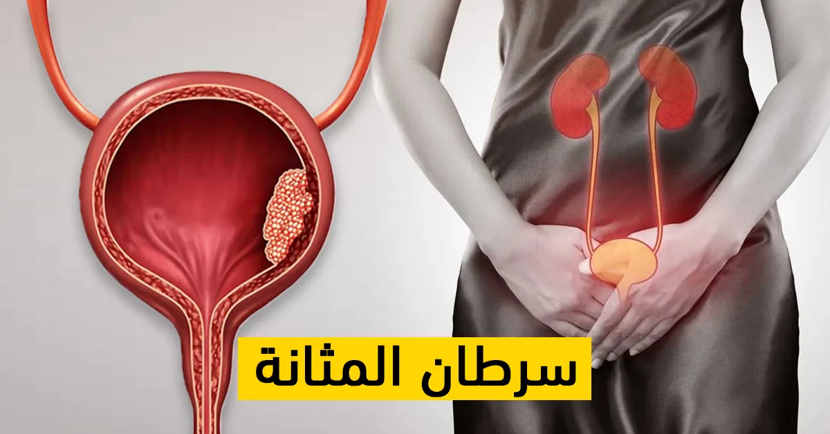 سرطان المثانة